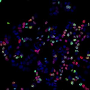 Androgen study could lead to new treatments for breast cancer